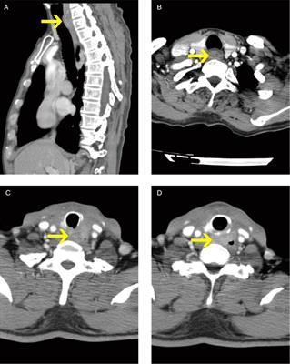 A modified tracheal transection approach for cervical esophageal lesion treatment: A report of 13 cases